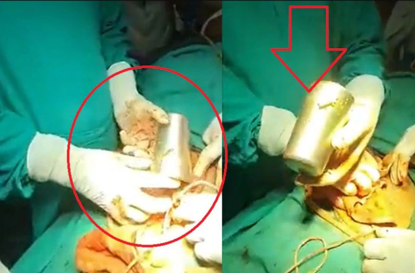  उत्तर प्रदेश/जौनपुर: डॉक्टर ने मरीज के पेट से निकाला स्टील का ग्लास, आखिर शरीर में कैसे गई इतनी बड़ी चीज?
